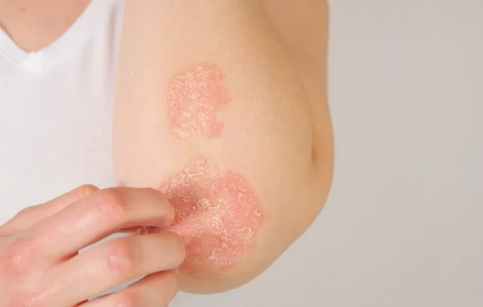 Psoriasis : Une découverte génétique majeure pourrait révolutionner le traitement des malades résistants Psoriasis : Une découverte génétique majeure pourrait révolutionner le traitement des malades résistants