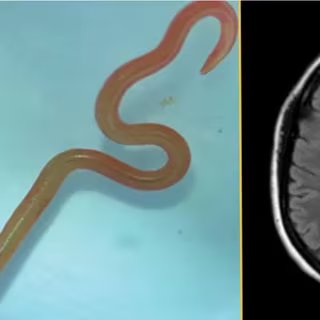 Cas clinique : un parasite inédit identifié chez une patiente après des mois d’errance diagnostique. © Hossain, M., Kennedy, K. J., Wilson, H. L., Spratt, D., Koehler, A., Gasser, R. B....Senanayake, S. N. (2023). Human Neural Larva Migrans Caused by Ophidascaris robertsi Ascarid. Emerging Infectious Diseases, 29(9), 1900-1903.